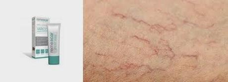 Remescar Arañas vasculares. Probado. ¿Aprobado? Remescar Arañas vasculares. Probado. ¿Aprobado?