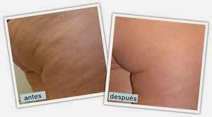 eliminar celulitis