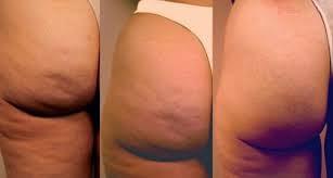 eliminar celulitis