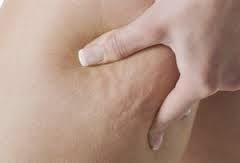 Remedios contra Celulitis