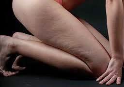 Remedios contra Celulitis