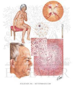 ¿Qué es la Polimialgia Reumática? artricenter arteritis