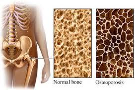Pérdida de densidad ósea en osteoporosis