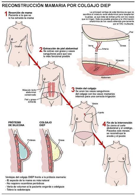 Reconstrucción mamaria técnica DIEP