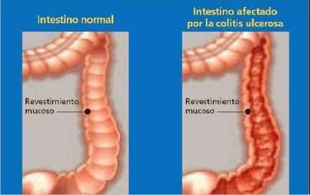 Consejos para la Colitis Ulcerosa