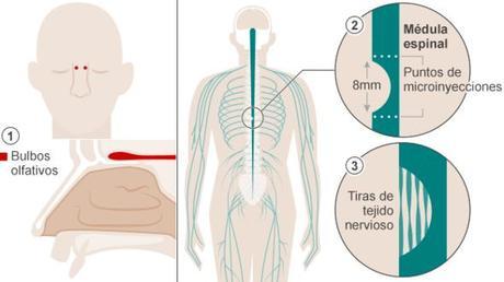 Un hombre que sufría de parálisis pudo volver a caminar después de someterse a una terapia pionera de trasplante de células de su cavidad nasal a la médula espinal.