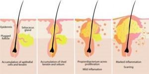 causas del acne