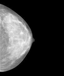 cáncer mama mamografía