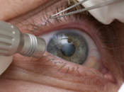 ¿Qué siente operarme cataratas?