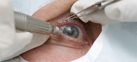 operarme de cataratas