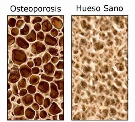 La osteoporosis, qué es y cómo tratarla