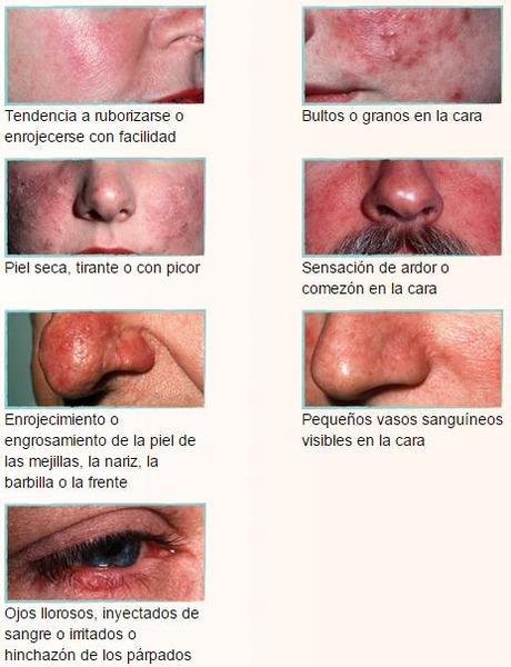 ¿Piel con rosacea?, planta cara al enrojecimiento