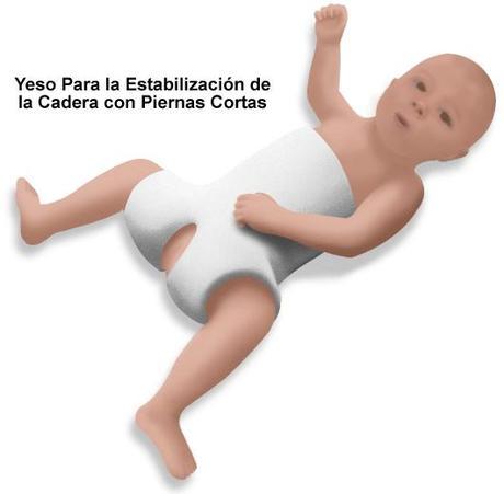 Lo que no sabiamos de la displasia de caderas