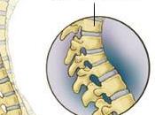 osteoporosis?