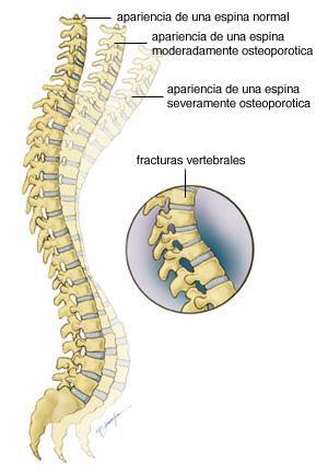 ¿ Qué es la osteoporosis?