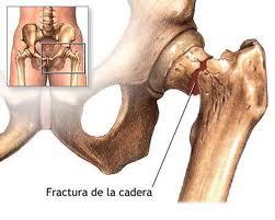 Hacer Pilates después de la cirugía ortopédica de prótesis de cadera