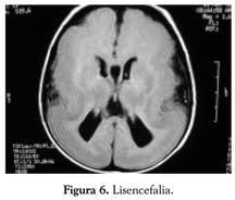 La Ezquizencefalia