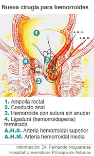 Una nueva cirugía ambulatoria evita las molestias del posoperatorio en las hemorroides