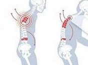 Casi millón hombres sufren España osteoporosis