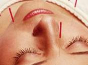 Beneficios Acupuntura para Pacientes Sufren Dolor