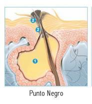 puntos-negros-y-espinillas