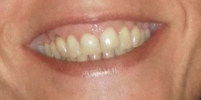 Enjuague bucal fluorado, enjuague bucal, enjuague, colutorio, fluor, crema dental, pasta de dientes, blanqueadora, dentrífico, elixir, cepillo dientes, salud, higiene, salud bucal, buco-dental