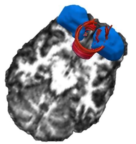 Alto consumo de marihuana encoge el cerebro pero compensa haciendo más conexiones