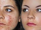 Como Reducir Acne Hormonal