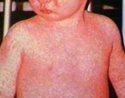 El Sarampión se Incrementa en el Mundo