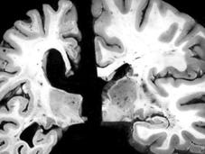 tratamiento elimina monos placas pueden causar alzhéimer