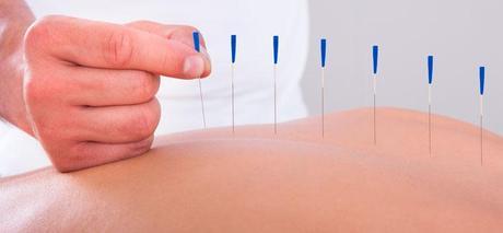 Artículo de Investigación , La Acupuntura ayuda a pacientes con cáncer Ayuda-acupuntura-a-pacientes-con-cancer
