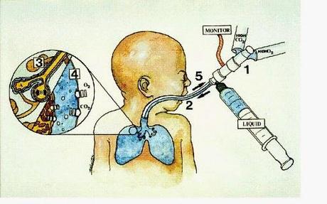 El perfluorocarbono, el líquido donde no se ahoga nadie