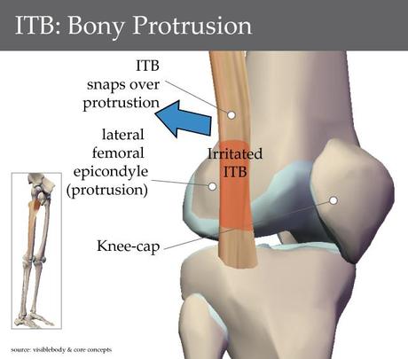 itb-over-bony-protrusion