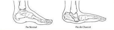 pie de charcot 
