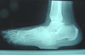 Enfermedad de Charcot, una causa del debilitamiento y destrucción del pie pie de charcot