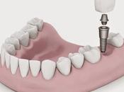 Implantes Dentales, ¿Qué Para Sirven?