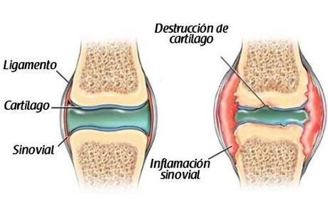 articulacion de rodilla en artrosis