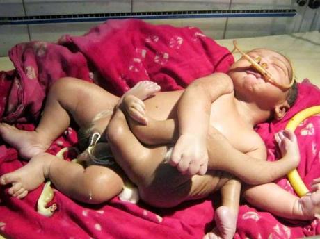 Nace en la India bebé con 8 extremidades y es considerado un Dios.