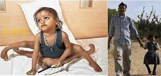Nace en la India bebé con 8 extremidades y es considerado un Dios.