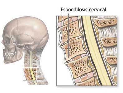 espondilosis