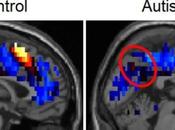 Representación cerebral pensamientos sociales podría predecir precisamente autismo