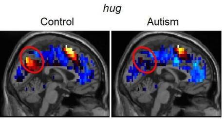 Representación cerebral de los pensamientos sociales podría predecir precisamente el autismo
