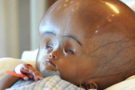 Nace niño en la India con dos cerebros en el mismo cuerpo 2minds2