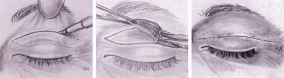 blefaroplastia-superior-dibujo