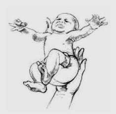 Reflejo de Moro -  Un reflejo impresciendible en el bebé pero muy molesto en edad infantil o adulta