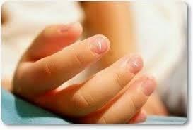 MANCHAS BLANCAS EN LAS UÑAS o LEUCONIQUIA