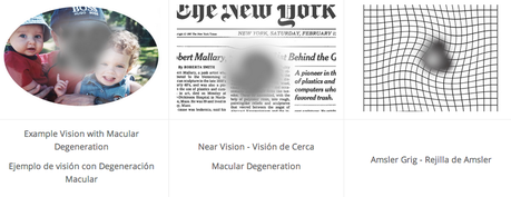 INNOVADOR TRATAMIENTO PARA LA DEGENERACIÓN MACULAR HÚMEDA