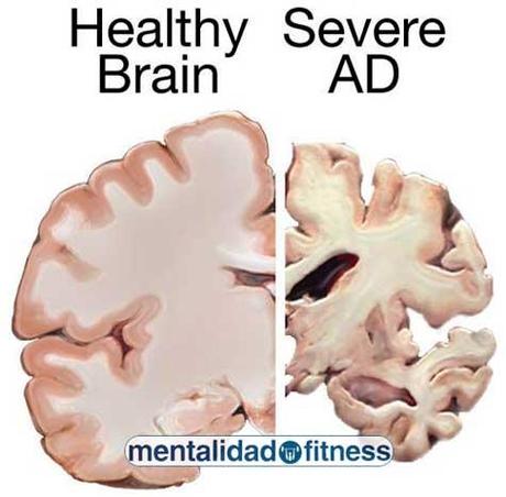 El alzheimer y beneficios de la actividad física.