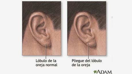 Pliegue diagonal en el lóbulo de la oreja y enfermedad cardiovascular
