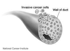 Nuevas pistas sobre cómo se propaga el cáncer